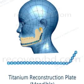 Reconstruction Plate; Titanium Reconstruction Plate (Mandible)